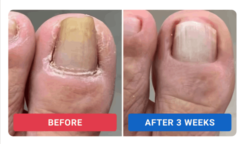 Orivelle Nail Fungus Pen review by Dan R. – Orivell
