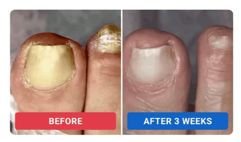 Orivelle Nail Fungus Pen review by Elena S. – Orivell