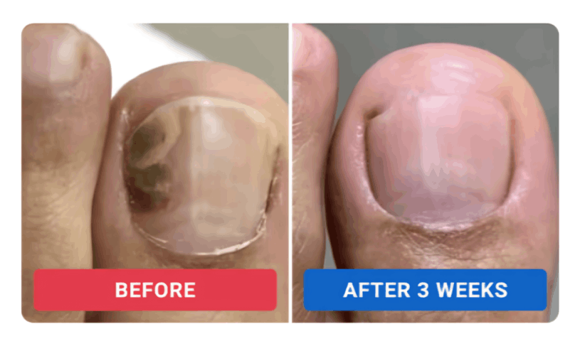 Orivelle Nail Fungus Pen review by Rachel M. – Orivell