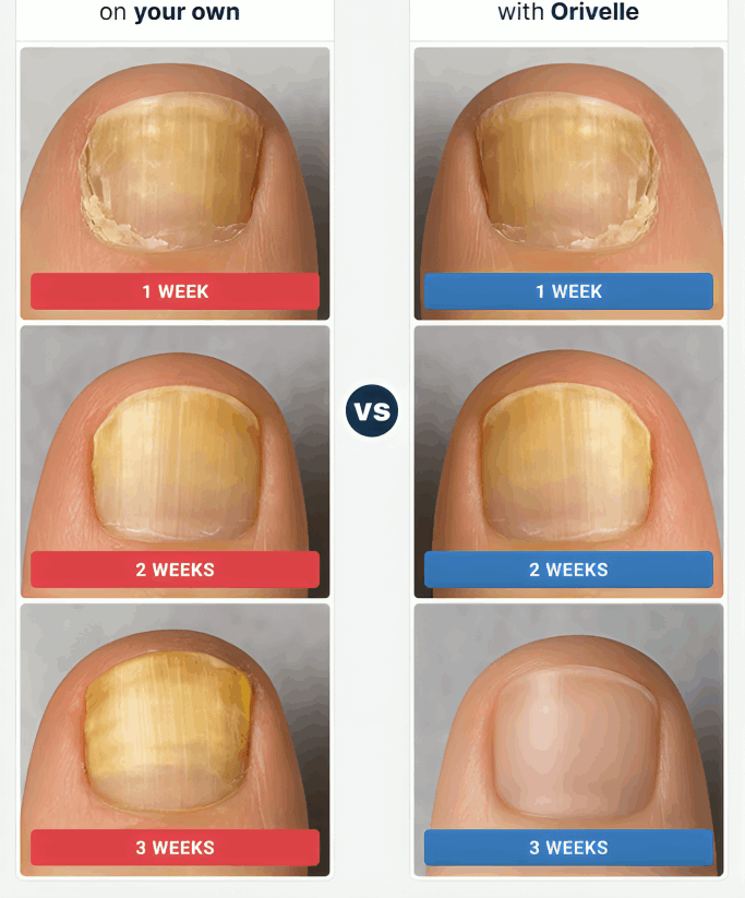 Orivelle Nail Fungus Pen before and after – Orivell
